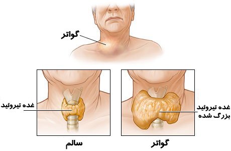 دانلود مقاله نقش تغذیه در بیماری گواتر