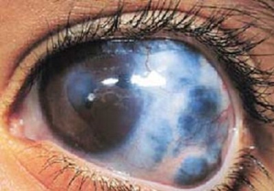 چشم و بیماری های آن