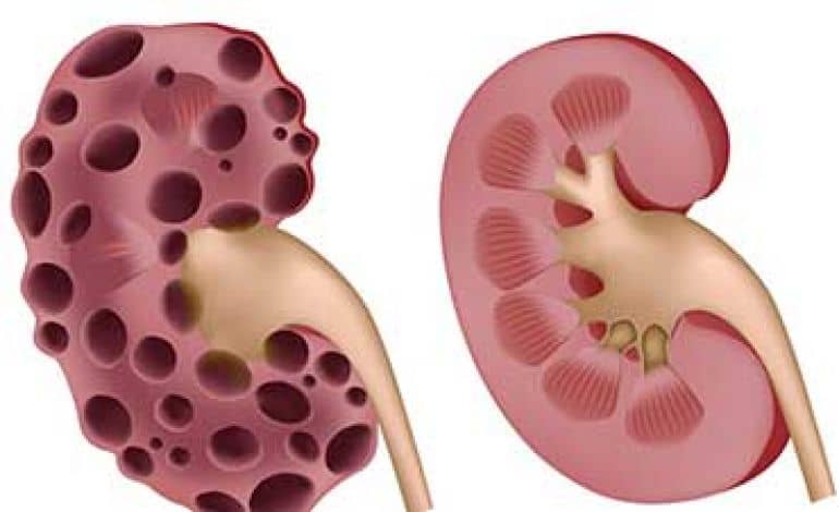 پاورپوینت بیماری های کلیوی در حاملگی