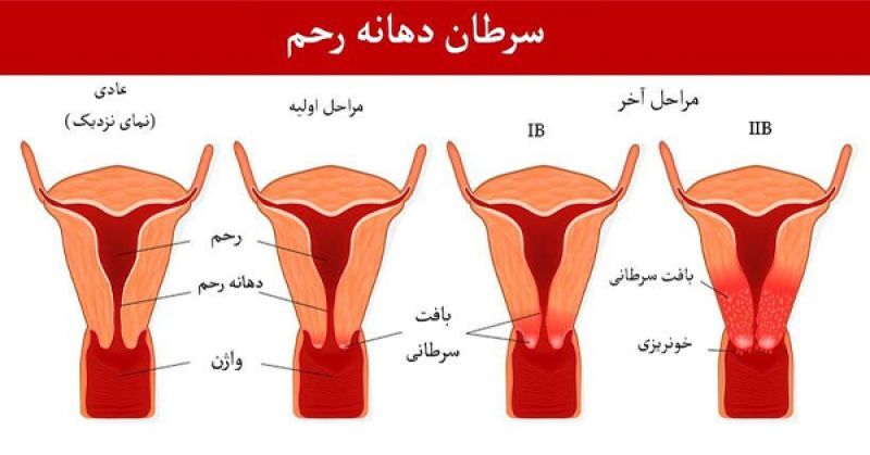 بررسی میزان آگاهی زنان باردار نسبت به غربالگری سرطان دهانه رحم بررسی میزان آگاهی زنان باردار نسبت به غربالگری سرطان دهانه رحم